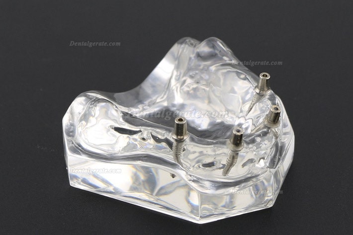 Anatomisches Modell der Zahnz&auml;hne &Uuml;berprothese Superior mit 4 Implantaten Demo Modell 6001